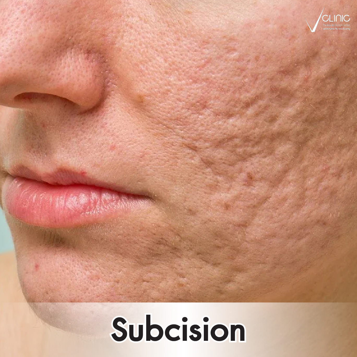 Subcision ตัดพังผืดหลุมสิว